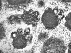 F,23y. | mast cell - granules with scroll-like formations - n. suralis, demyelinating neuropathy